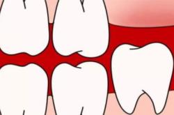 嘴巴里长智齿还在肉里怎么办