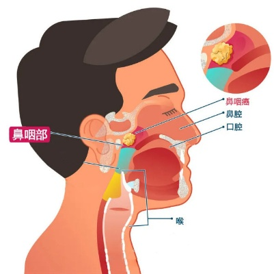 鼻咽癌南方高发之谜，探寻背后的原因与应对策略